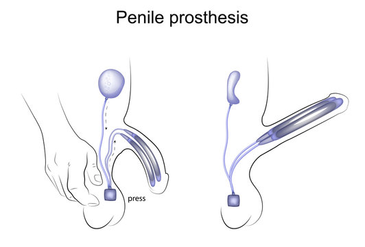 protese peniana